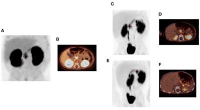 Case Report: Two Distinct Focal Congenital Hyperinsulinism Lesions Resulting From Separate Genetic Events